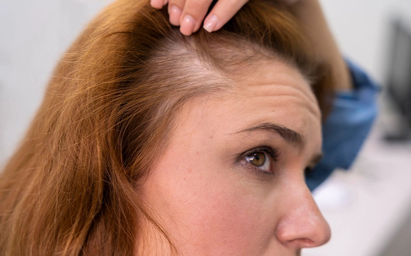 Female Pattern Hair loss