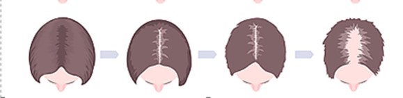 hair loss